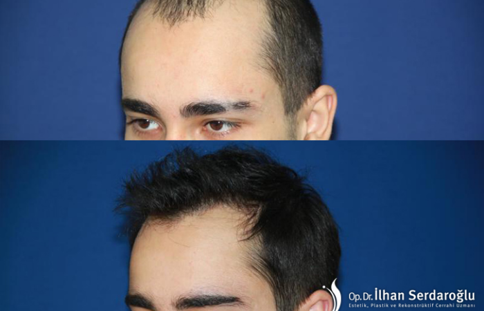 After how many days do the grafts start to live after hair transplantation?