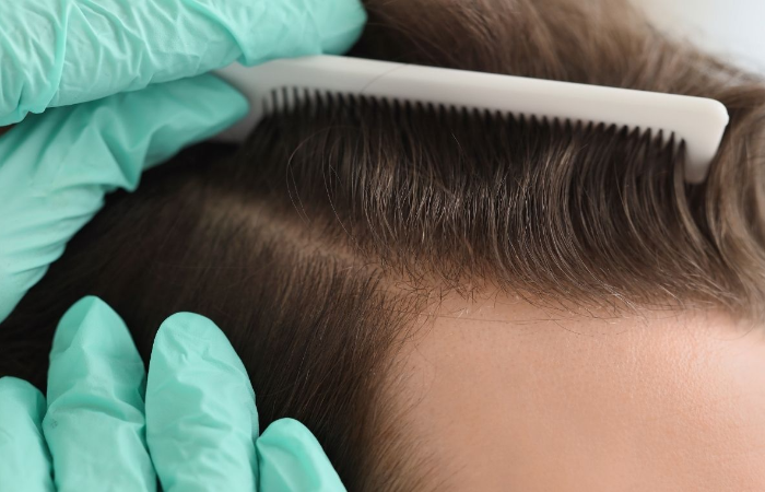 Hair Loss in Men