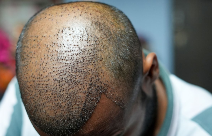 What to Pay Attention to After Hair Transplantation 