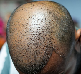 What to Pay Attention to After Hair Transplantation 