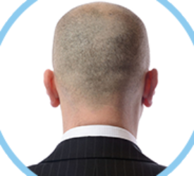 Hair Transplant By FUT Method 