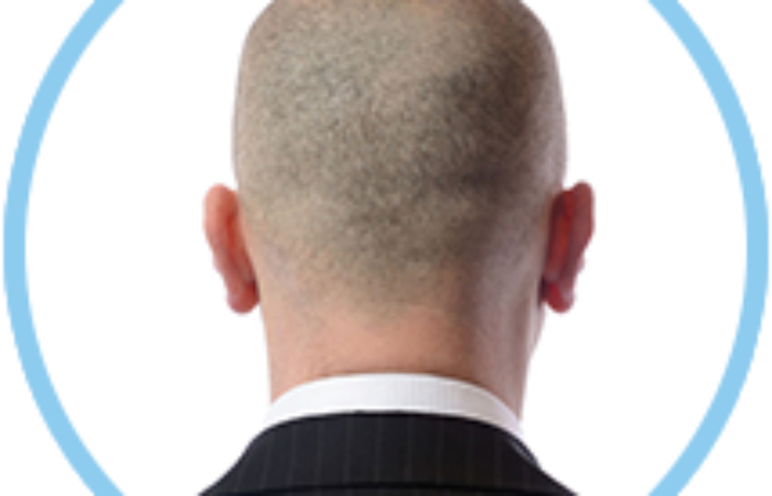 Hair Transplant By FUT Method 