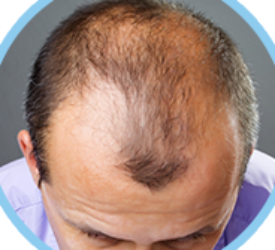 Camouflage The Scars of the Previous Operation Due to FUT Hair Transplantation 