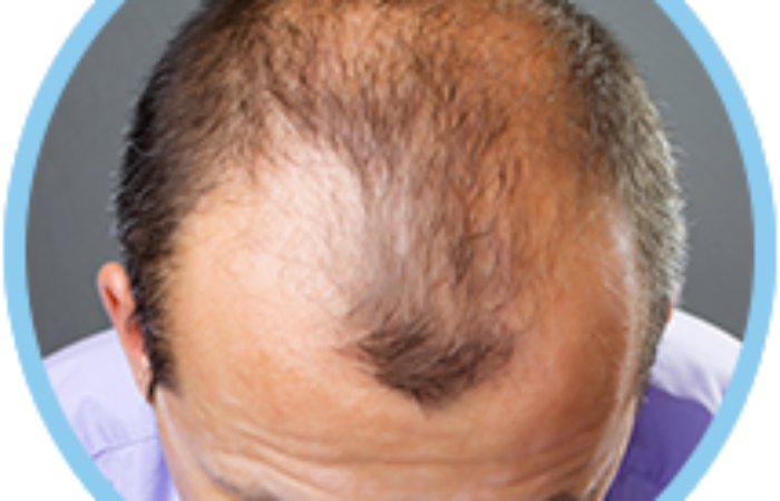 Camouflage The Scars of the Previous Operation Due to FUT Hair Transplantation 