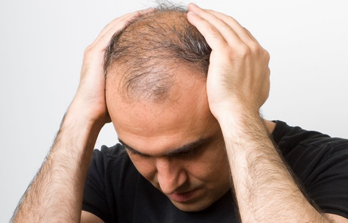 Saw Palmetto İle Saç Kaybi Doğal Yolla Önlenebilir mi?